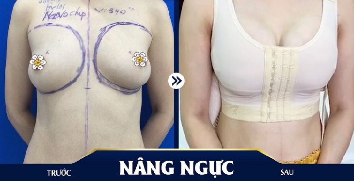 Trước và sau khi nâng ngực tại Bệnh viện thẩm mỹ Kangnam