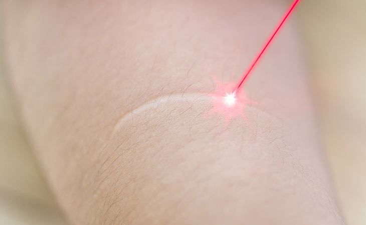 Thẩm mỹ viện trị sẹo trắng Oasis spa ứng dụng công nghệ laser vào trong điều trị sẹo