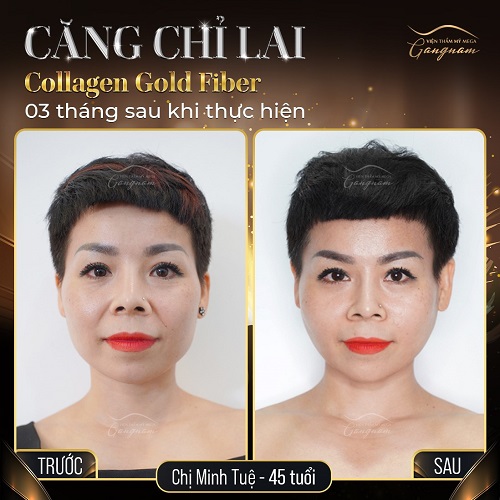 Công nghệ Collagen Gold Fiber
