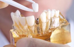 7 Địa Chỉ Trồng Răng Implant Ở Hà Nội Uy Tín, Tốt Nhất Bạn Nên Đến