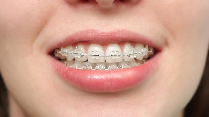 Niềng răng giúp bạn không cần trồng răng giả hay bọc sứ