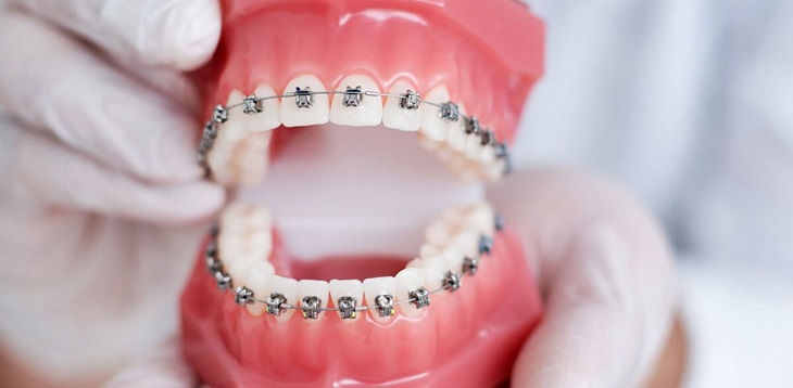 Niềng răng là một phương pháp điều chỉnh lại vị trí của các răng trên cung hàm