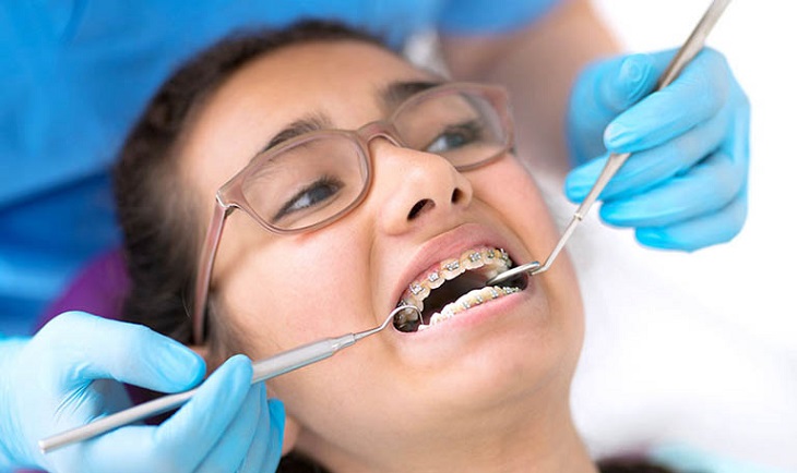 Bạn đến nha khoa tái khám và theo dõi sự dịch chuyển của răng