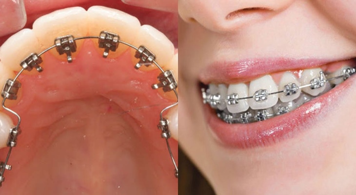 So sánh phương pháp niềng răng mặt ngoài và mặt trong