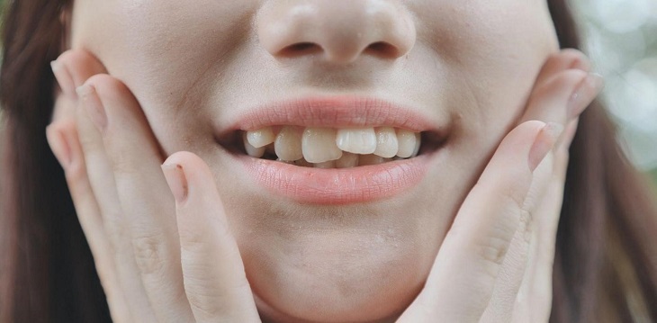 Những trường hợp răng mọc lệch, sai khớp cắn đều có thể niềng mắc cài mặt trong