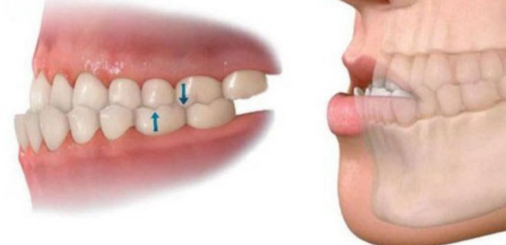Răng móm là tình trạng hàm răng bị khớp cắn ngược gây ảnh hưởng đến thẩm mỹ