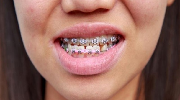Chi phí niềng răng móm bao nhiêu còn phụ thuộc vào nhiều yếu tố
