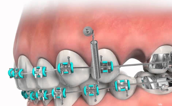 Cắm vít niềng răng hay bắt minivis niềng răng là phương pháp chỉnh nha mang đến hiệu quả khá cao
