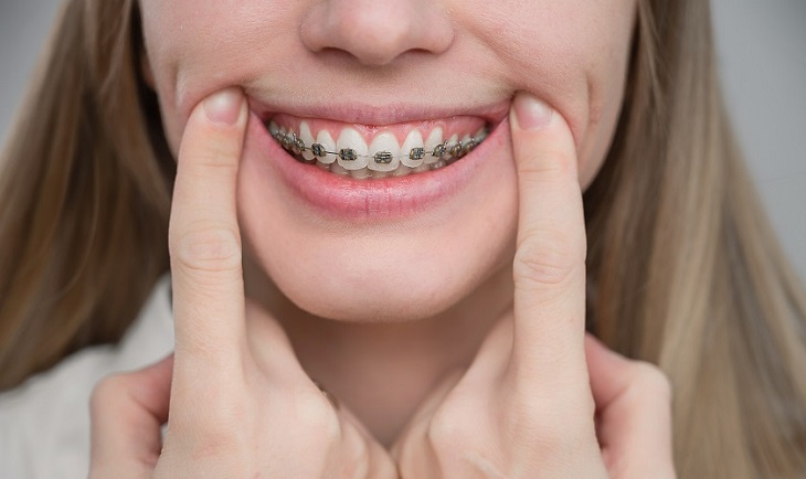 Niềng răng mắc cài kim loại là phương pháp thẩm mỹ răng miệng phổ biến nhất hiện nay