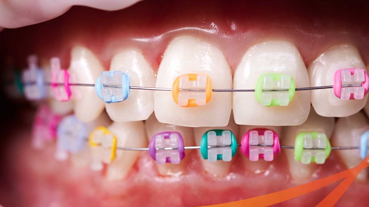 Giá niềng răng mắc cài kim loại phụ thuộc vào các bệnh răng miệng