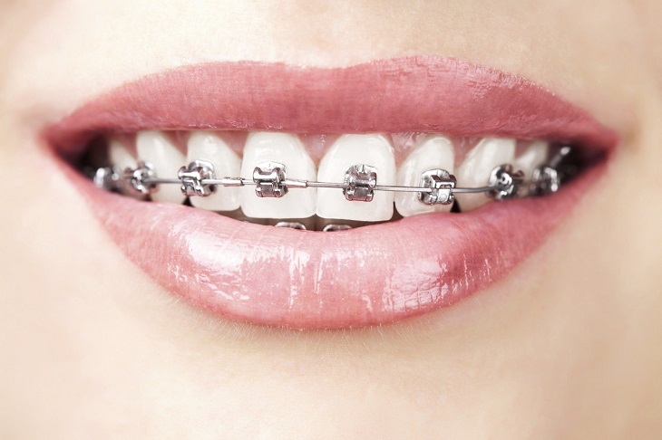 Khí cụ niềng răng được dùng để hỗ trợ quá trình chỉnh nha cho người bệnh