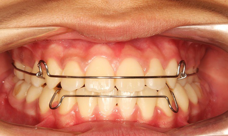 Bất cứ phương pháp niềng răng nào cũng cần đeo hàm duy trì