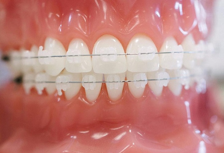 Người niềng răng thực hiện kỹ thuật niềng pha lê hiện đại