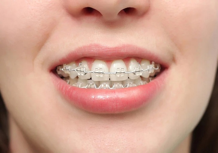 Niềng pha lê phù hợp cho mọi đối tượng gặp các vấn đề về răng miệng