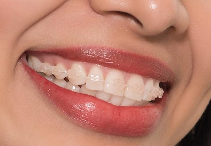 Niềng răng sử dụng mắc cài pha lê có tính thẩm mỹ và hiệu quả chỉnh nha được đánh giá cao