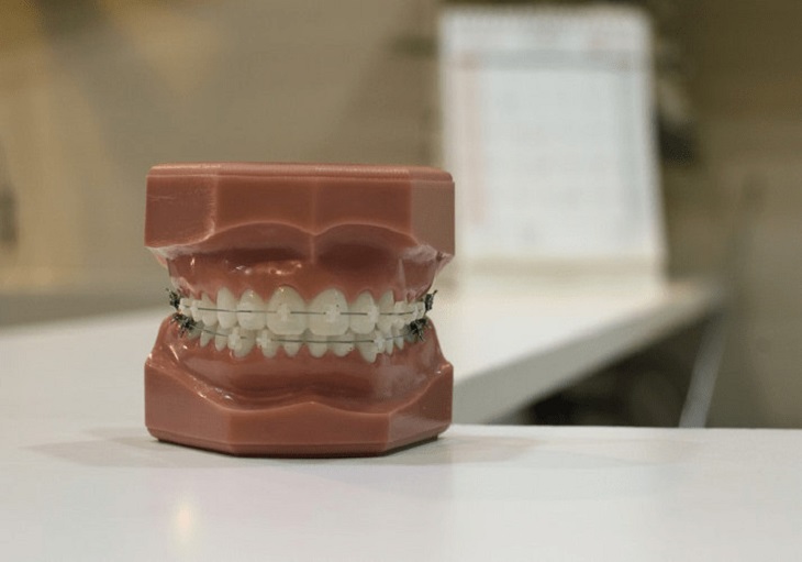 Quy trình niềng răng sẽ kéo dài từ 2 - 3 năm tính cả thời gian đeo hàm duy trì