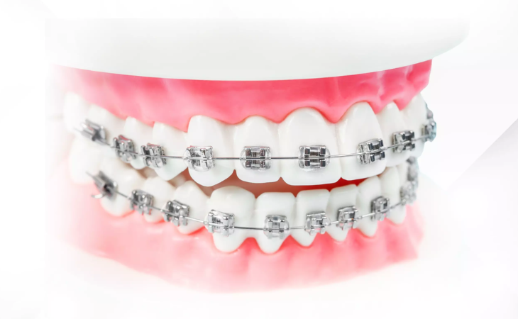 Niềng răng là loại hình nha khoa chuyên điều trị các vấn đề sai lệch về răng