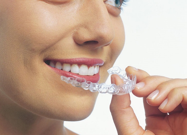 Niềng răng 3D Clear là phương sở hữu nhiều ưu điểm vượt trội, phù hợp với nhiều đối tượng