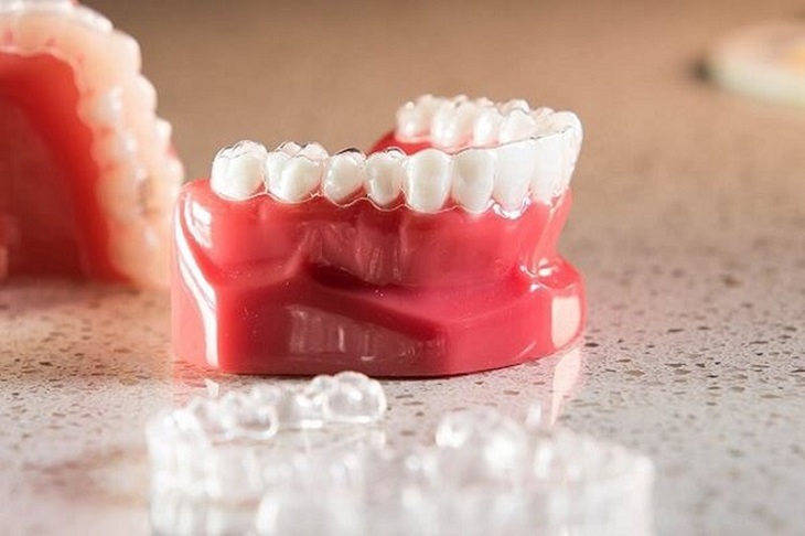 Niềng răng 3D Clear chi phí cho một ca niềng từ 50 - 70 triệu đồng