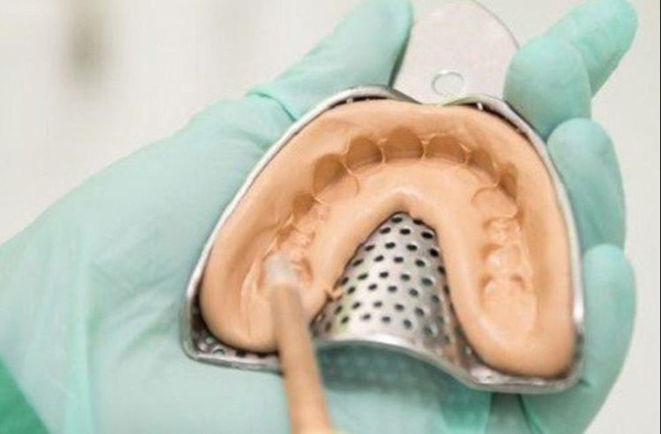 Việc lấy mẫu dấu hàm chính xác rất quan trọng trong quá trình niềng răng