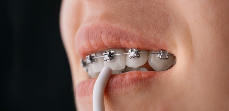 Niềng răng mắc cài kim loại là phương pháp niềng răng được nhiều người áp dụng