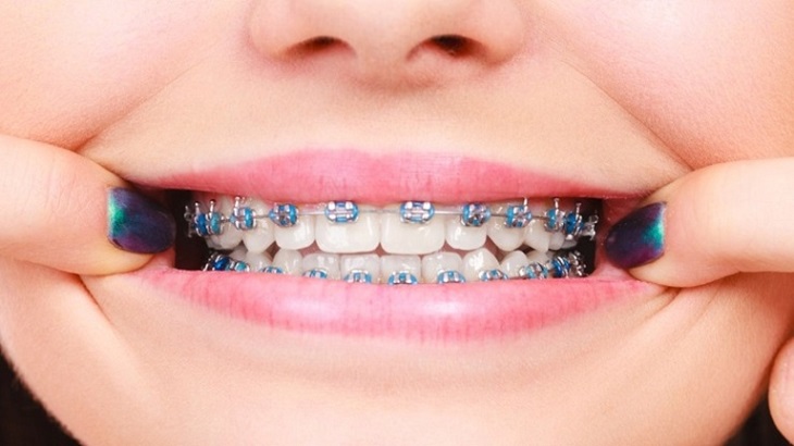 Chi phí niềng răng kim loại giá bao nhiêu còn tùy thuộc vào nhiều yếu tố