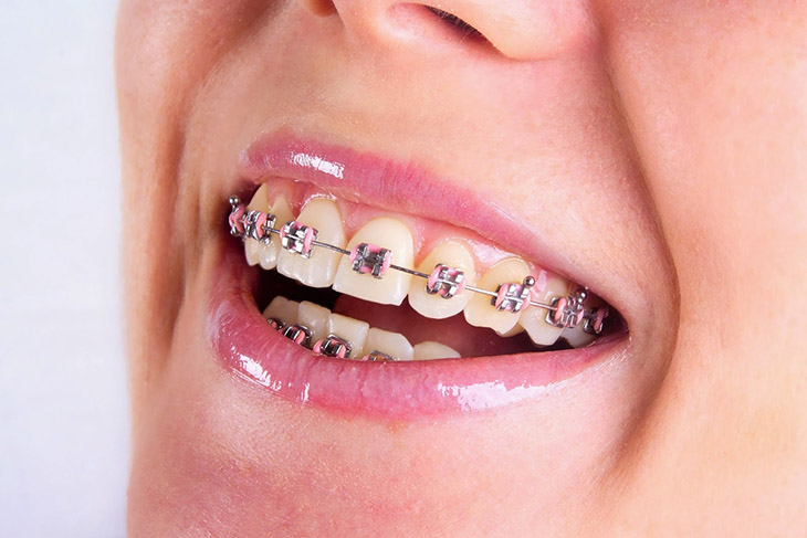 Niềng răng mắc cài là phương pháp truyền thống, đã ra đời từ lâu