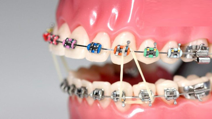 Chi phí niềng răng mắc cài kim loại phụ thuộc vào nhiều yếu tố