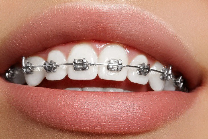 Niềng răng mắc cài kim loại tự đóng là phương pháp được dùng phổ biến hiện nay