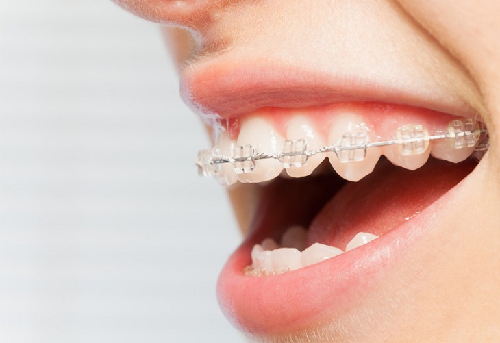 Chi phí và thời gian niềng răng phụ thuộc khá nhiều vào tính trạng răng miệng của mỗi người