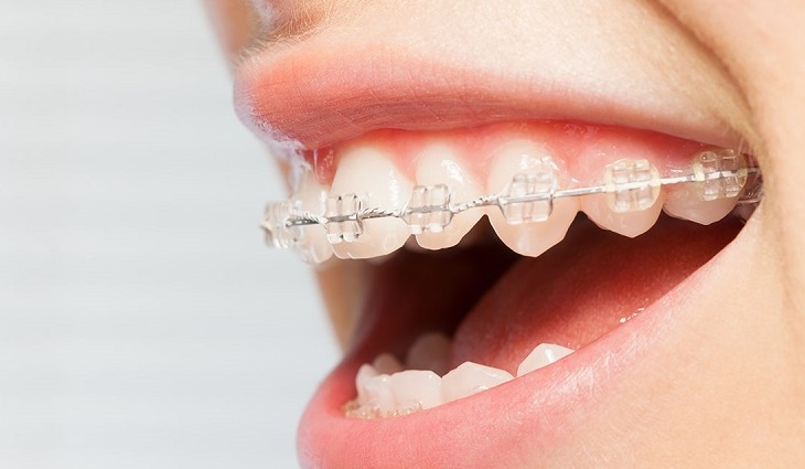 Quy trình niềng răng của mỗi người được thực hiện qua 5 bước kéo dài từ 1 - 3 năm