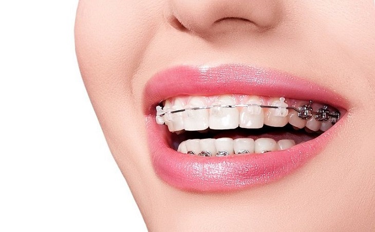 Thời gian và chi phí niềng răng phụ thuộc rất nhiều vào tình trạng răng miệng của mỗi người