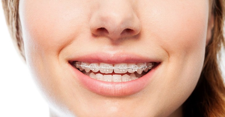 Dù có nhược điểm nhưng niềng răng sứ vẫn được đánh giá cao nhờ hiệu quả mang lại