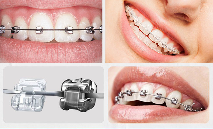 Quy trình niềng răng mắc cài tự buộc tương tự như với loại mắc cài khác