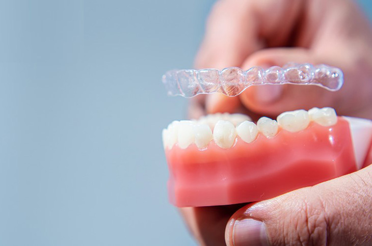 Máng niềng nhựa giúp xử lý các khuyết điểm răng trong nhiều trường hợp