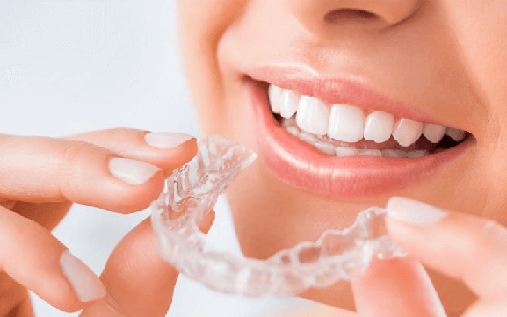 Chi phí niềng răng nhựa còn phụ thuộc vào nhiều yếu tố