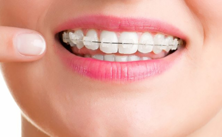 Niềng răng sứ (niềng răng mắc cài sứ) là phương pháp chỉnh nha sử dụng chất liệu sứ