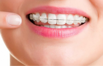 Niềng Răng Sứ: Phân Loại, Quy Trình Thực Hiện Và Bảng Giá