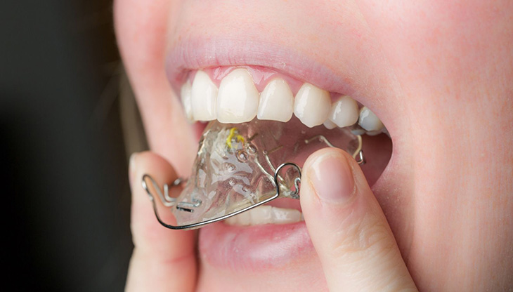 Niềng răng tháo lắp kim loại ít nhiều vẫn sẽ gây đau nhức