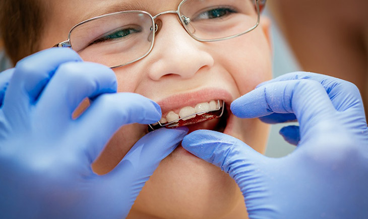 Niềng kim loại tháo lắp phù hợp với trẻ nhỏ trong giai đoạn phát triển răng