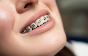 Niềng răng là gì? Các loại niềng răng hiệu quả nhất hiện nay