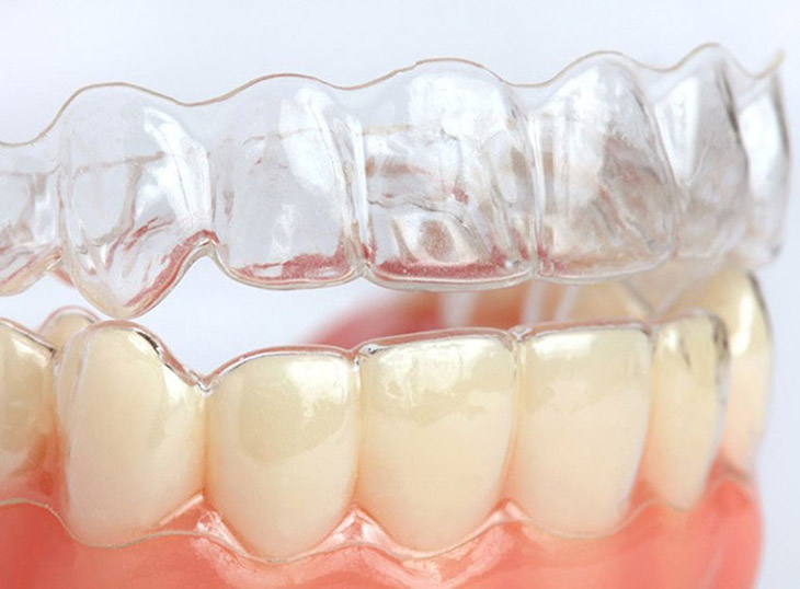 Niềng răng 3D Clear Aligner sử dụng khay nhựa 3D trong suốt