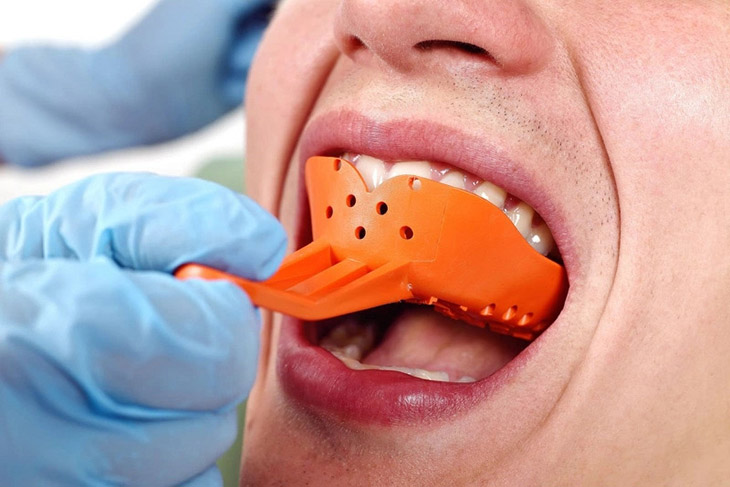 Việc lấy dấu răng được thực hiện ở mọi bệnh nhân