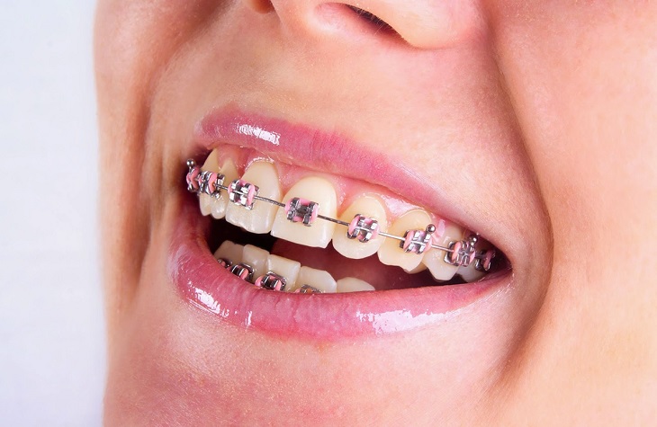 Niềng răng mắc cài kim loại là phương pháp chỉnh nha phổ biến