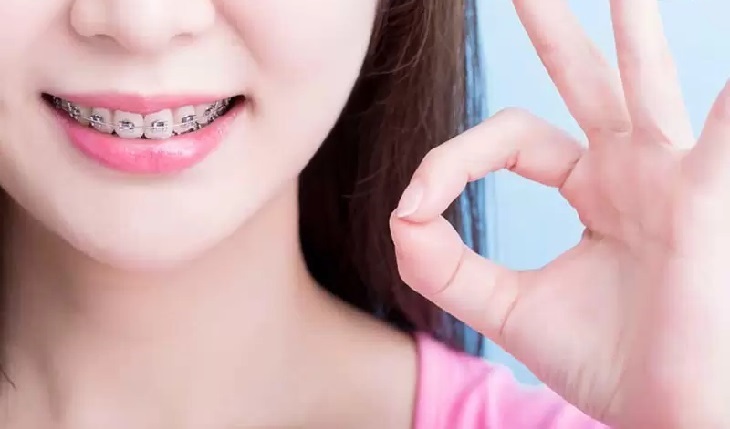 Niềng răng ở tuổi 20 vẫn có thể đả được hiệu quả cao