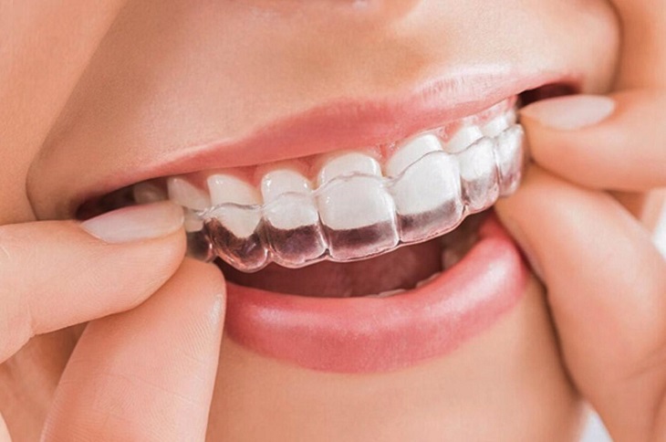 Niềng răng Invisalign là không gây đau nhức cho người dùng