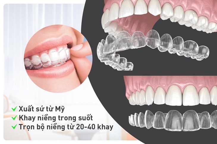 Niềng răng Invisalign là phương pháp chỉnh nha hiện đại