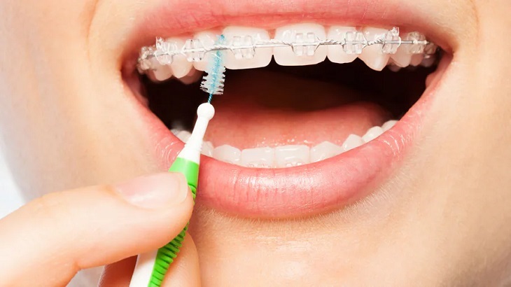 Chú ý chăm sóc, vệ sinh răng miệng sạch sẽ sau khi niềng răng