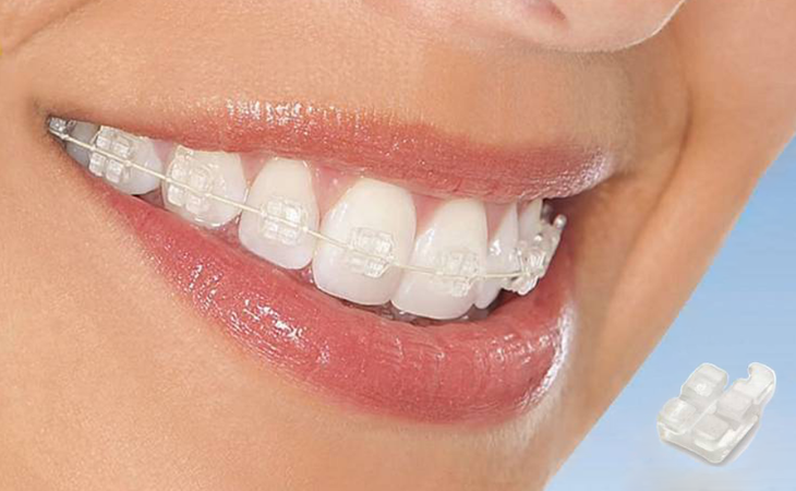 Chi phí niềng răng ở mỗi bệnh nhân sẽ có sự khác biệt, chịu tác động của nhiều yếu tố