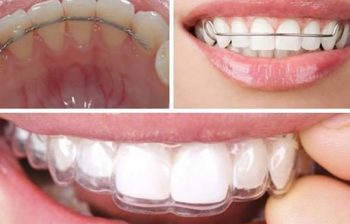 Hàm Duy Trì Sau Niềng Răng Là Gì? Cách Sử Dụng Và Lưu Ý